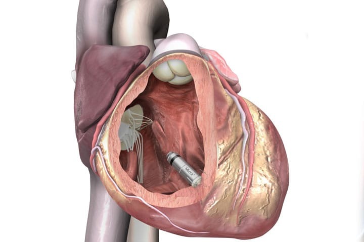 تأثیر آهنربا بر ضربان ساز قلب