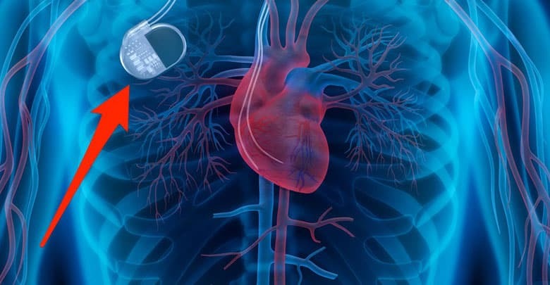 تأثیر آهنربا بر ضربان ساز قلب